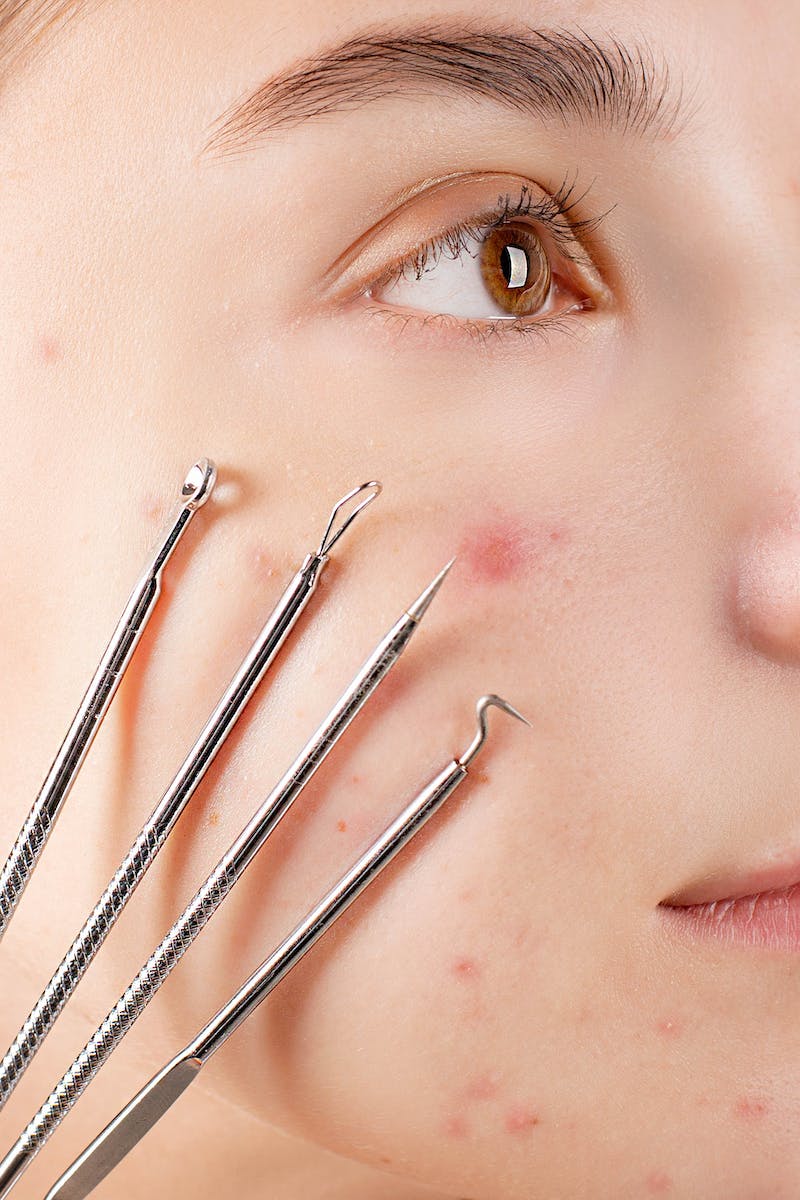 Microneedle Treatment For Acne Scarring: A Personal Review.